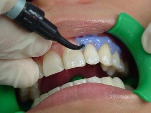 Limpieza y Blanqueamiento dental