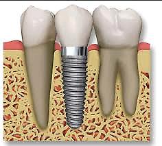 Odontologia implantes protesis
