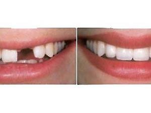 Provisorios Dentales para Eventos, Arreglos Urgentes,