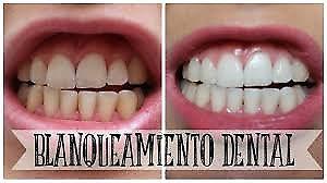 Blanqueamiento Dental Rosario