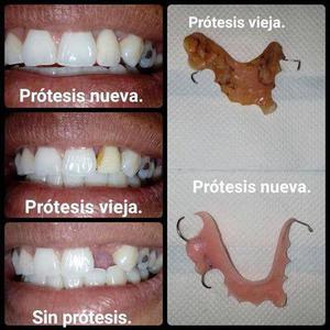 protesis dentales DE ACRILICO agregado de dos o tres dientes