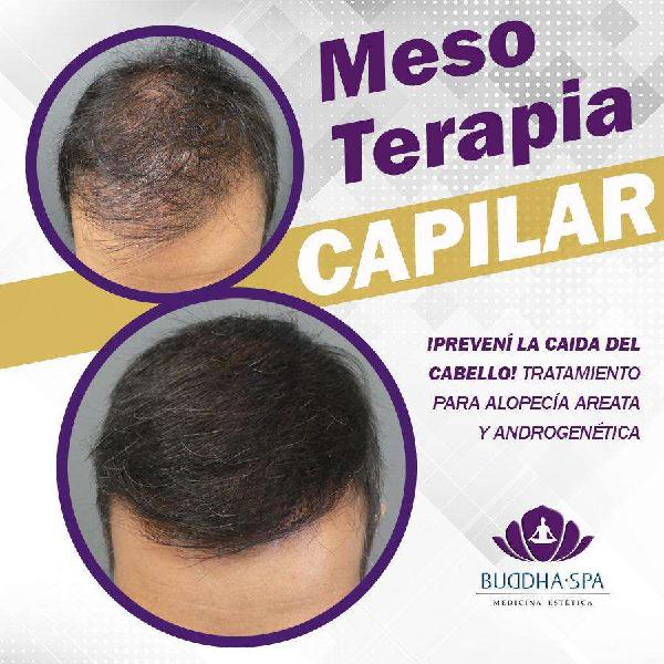Mesoterapia Capilar