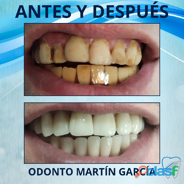 PRÓTESIS DENTALES / ODONTO MARTÍN GARCÍA